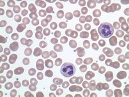 Chronic Lymphocytic Leukemia blood