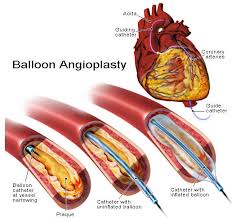 Angioplasty  Abroad