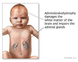 Neonatal  Adrenoleukodystrophy 