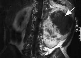 http://radiographics.rsna.org/content/25/2/455/F49.large.jpg