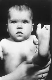 File:Thalidomide Baby.jpg - via Daymix