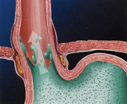 Images of  Reflux   Laryngitis