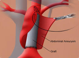  open abdominal aortic aneurysm 