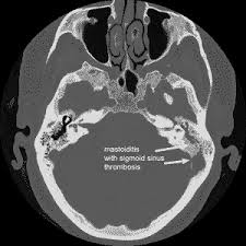 http://www.bcm.edu/oto/jsolab/tm_me_mastoid/mastoiditis-with-sigmoid-si.gif