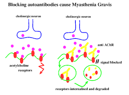 myasthenia gravis
