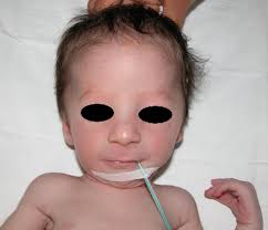 Prader Willi syndrome