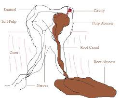 Tooth  abscess  Pictures