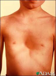  Aarskog syndrome 