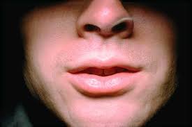 DRY MOUTH Xerostomia
