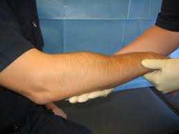  broken bone 