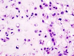 http://upload.wikimedia.org/wikipedia/commons/f/fe/Chondrosarcoma_(4).jpg