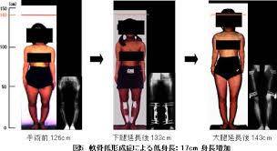図5 軟骨低形成症による低身長：