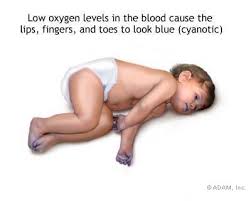  Cyanotic heart disease 