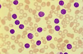 Chronic lymphocytic leukemia