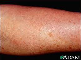 http://www.nlm.nih.gov/medlineplus/ency/images/ency/fullsize/2438.jpg