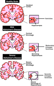 Alzheimers Support Blog &Acirc;&raquo; Classification of Alzheimer's