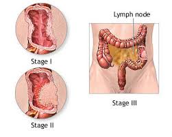 colon_cancer5.jpg