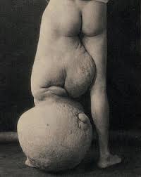  suffered from Proteus syndrome; 