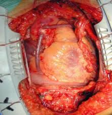 The result of the heart