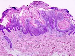 of a  seborrheic keratosis .
