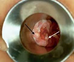 Chronic fissure