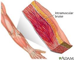 Muscle  bruise 
