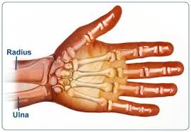  Colle's fracture  is a  wrist 