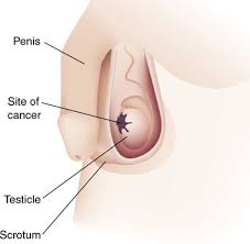 Certain  testicular  tumors