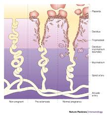 Pre-eclampsia is a complication of 