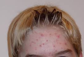 http://www.doctorsecrets.com/blog/wp-content/uploads/2009/10/Acne2.jpg