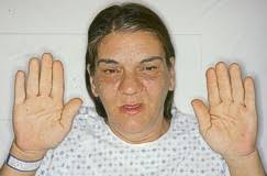 tumors ( acromegaly )