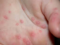 Hand-Foot-Mouth Disease
