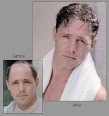 Hair loss treatment