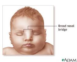   Broad   nasal bridge