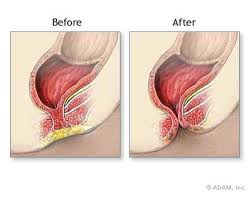 Imperforate Anus Repair