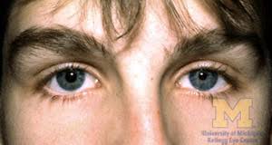  Anisocoria 