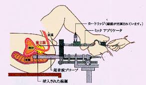 前立腺がんに対する放射線療法に