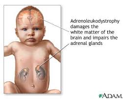 Neonatal  adrenoleukodystrophy 