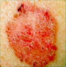  squamous cell skin cancer 