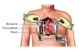 in  aortic valve surgery .