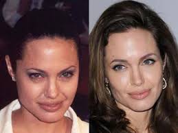 Celebrities, Botox
