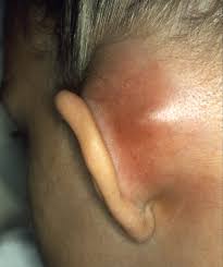 http://de.academic.ru/pictures/dewiki/77/Mastoiditis1.jpg