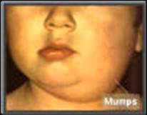 Mumps is an infection caused by a