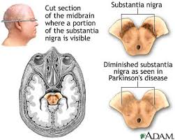 Parkinson's disease is a - via Daymix