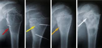 http://plasticsurgerynotes.net/hand/tumors/bone/unicam11.jpg