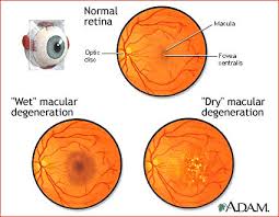  Macular degeneration 