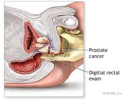  prostate cancer  disease.