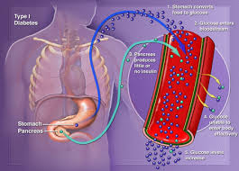 Type 1 Diabetes Vaccine