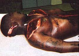 PICTURE 3: 2PAC'S AUTOPSY PIC... (Click here to enlarge)