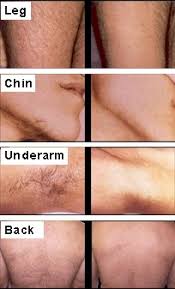 Laser Hair Removal Informative
